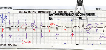 Advanced ECG